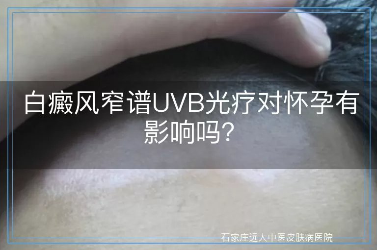 白癜风窄谱UVB光疗对怀孕有影响吗？