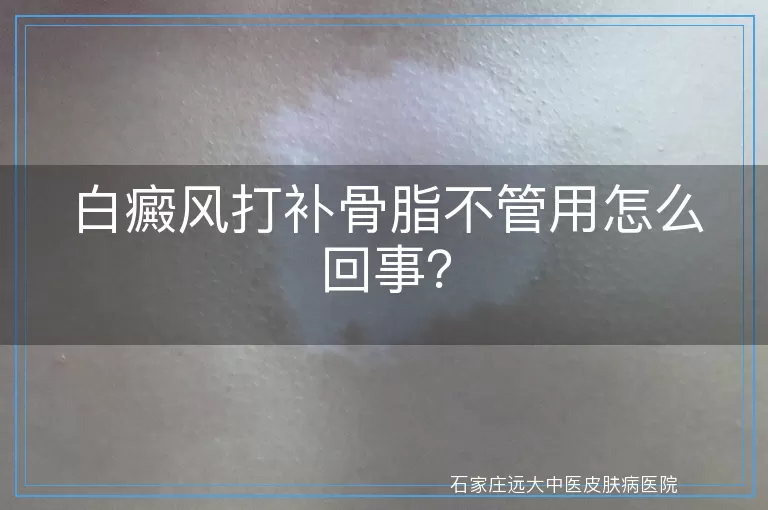 白癜风打补骨脂不管用怎么回事？