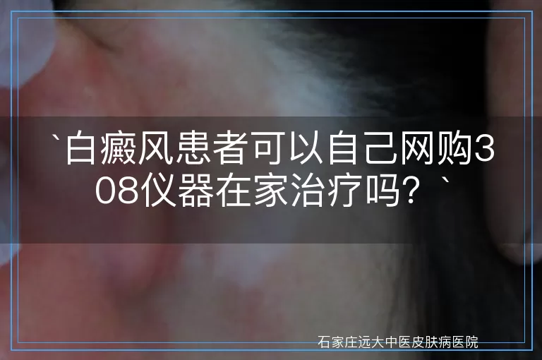 白癜风患者可以自己网购308仪器在家治疗吗？