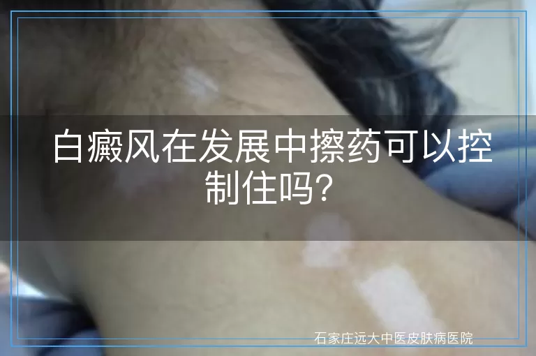 白癜风在发展中擦药可以控制住吗？