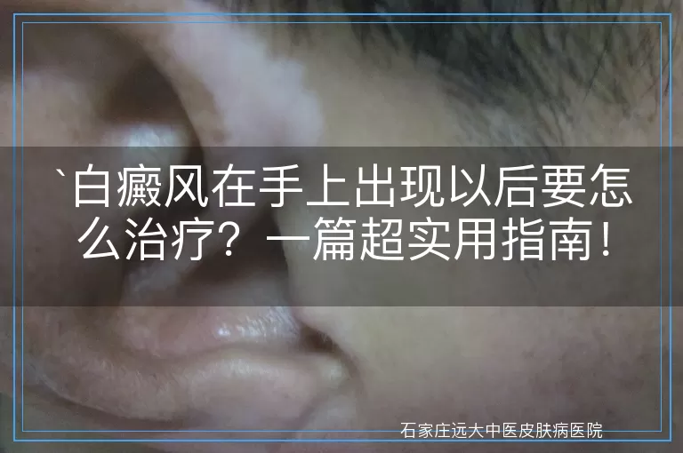 白癜风在手上出现以后要怎么治疗？一篇超实用指南！