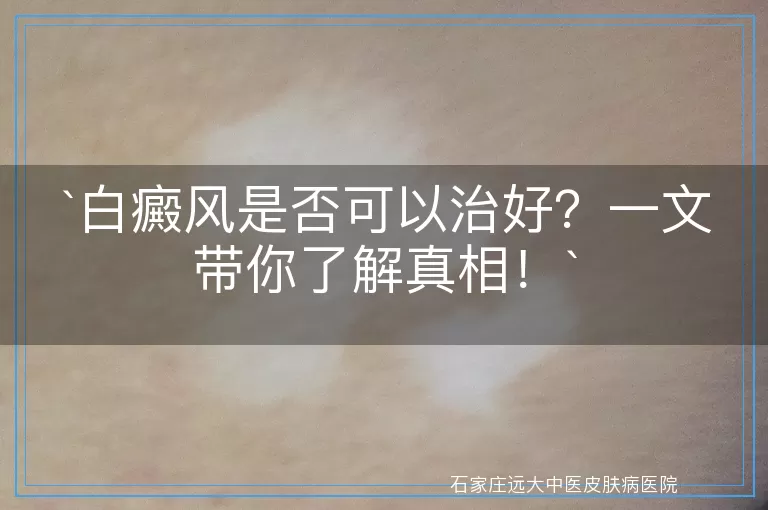 白癜风是否可以治好？一文带你了解真相！
