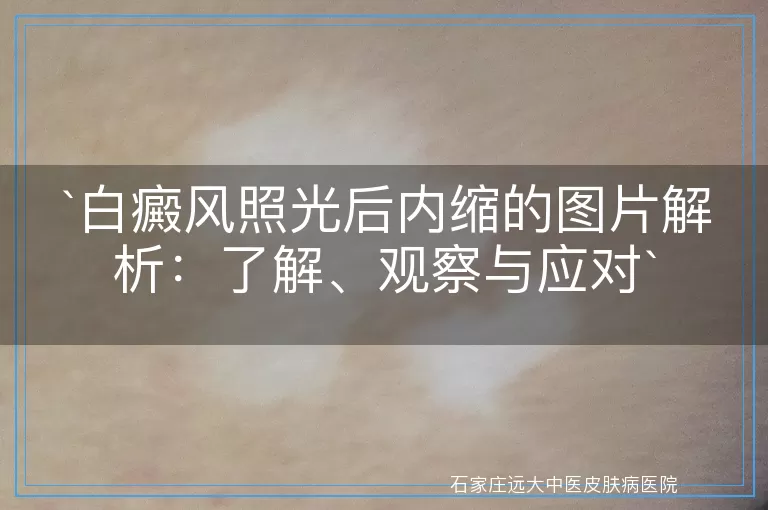 白癜风照光后内缩的图片解析：了解、观察与应对