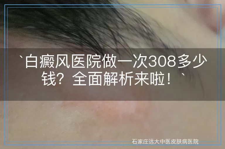 白癜风医院做一次308多少钱？全面解析来啦！