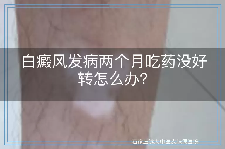 白癜风发病两个月吃药没好转怎么办？
