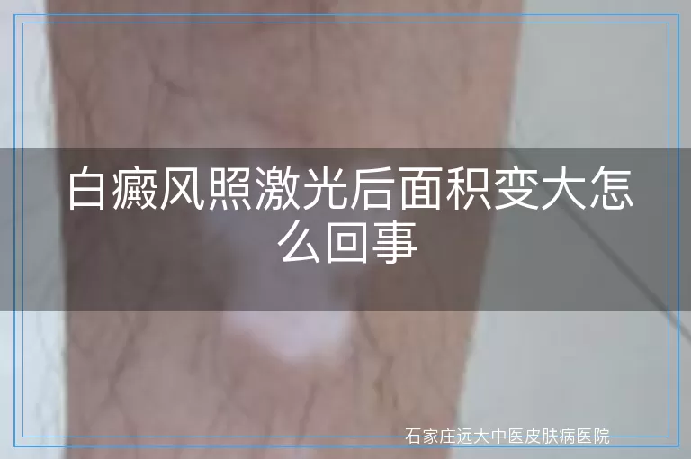 白癜风照激光后面积变大怎么回事