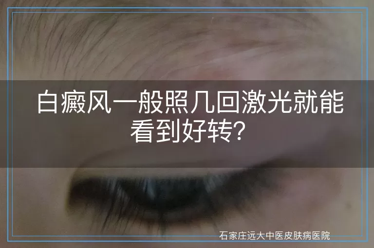 白癜风一般照几回激光就能看到好转？