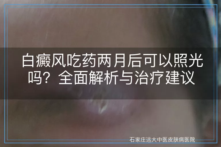 白癜风吃药两月后可以照光吗？全面解析与治疗建议