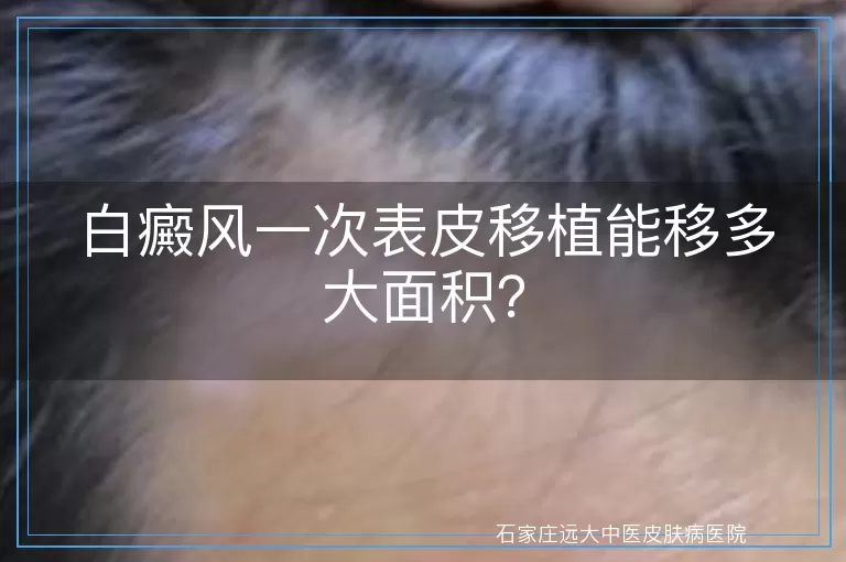 白癜风一次表皮移植能移多大面积？