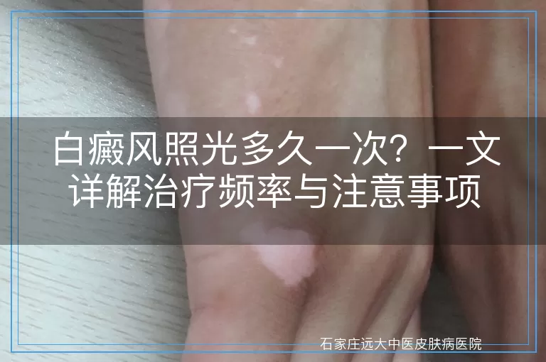 白癜风照光多久一次？一文详解治疗频率与注意事项