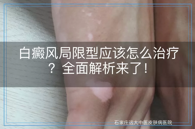 白癜风局限型应该怎么治疗？全面解析来了！