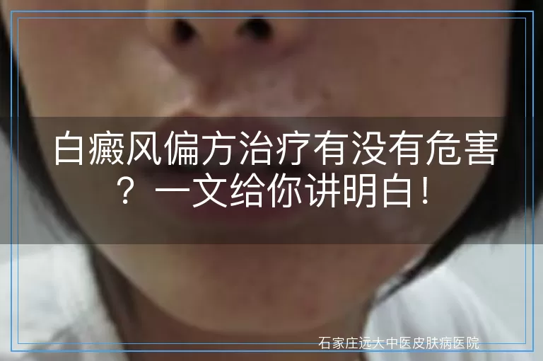 白癜风偏方治疗有没有危害？一文给你讲明白！