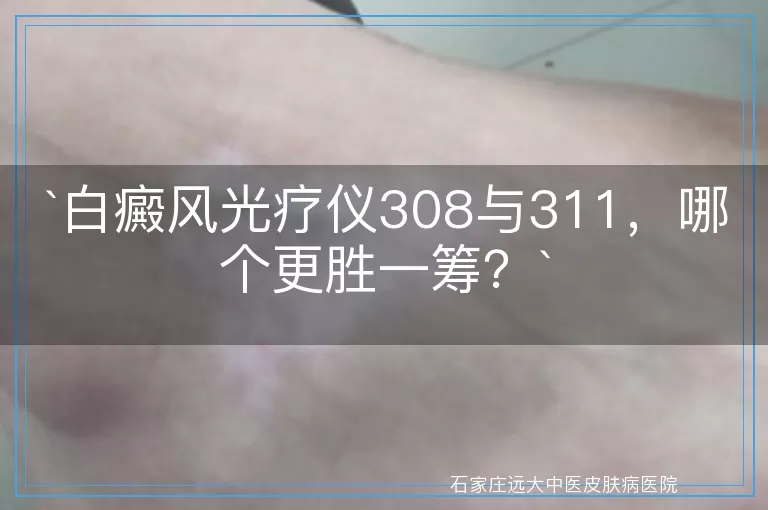 白癜风光疗仪308与311，哪个更胜一筹？