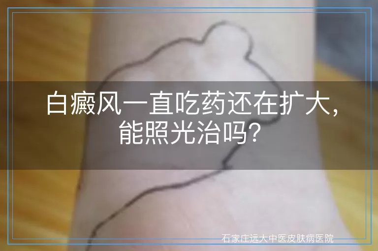 白癜风一直吃药还在扩大，能照光治吗？