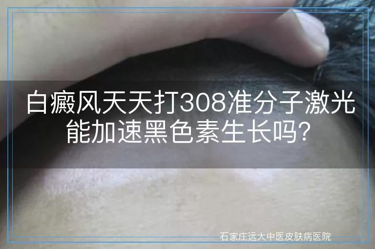 白癜风天天打308准分子激光能加速黑色素生长吗？