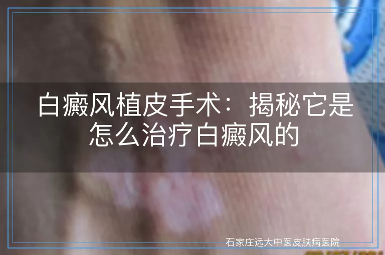 白癜风植皮手术：揭秘它是怎么治疗白癜风的