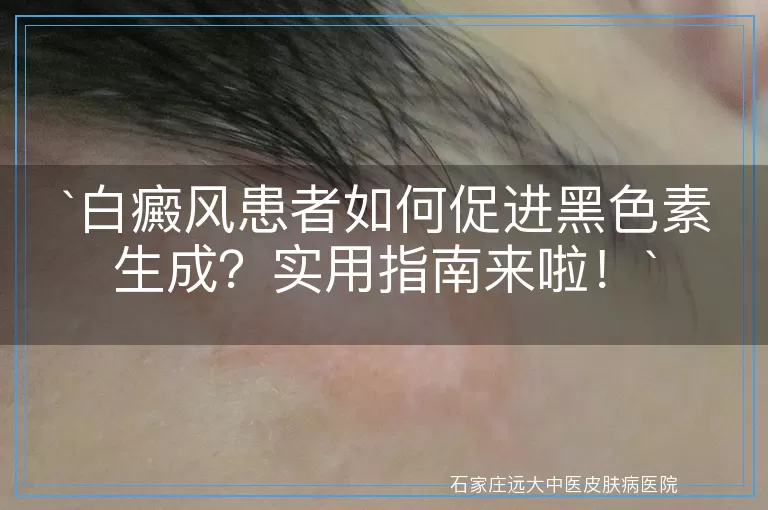 白癜风患者如何促进黑色素生成？实用指南来啦！