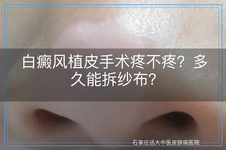 白癜风植皮手术疼不疼？多久能拆纱布？