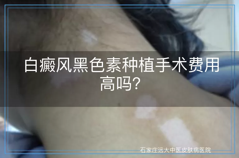 白癜风黑色素种植手术费用高吗？