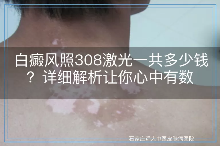 白癜风照308激光一共多少钱？详细解析让你心中有数