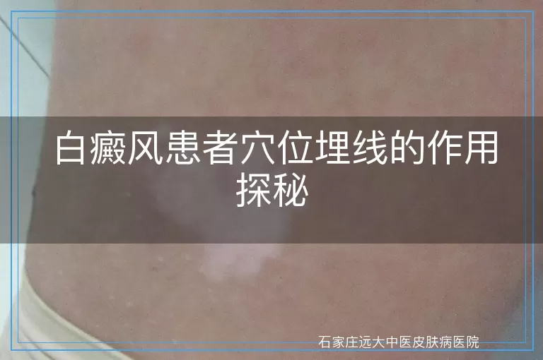 白癜风患者穴位埋线的作用探秘