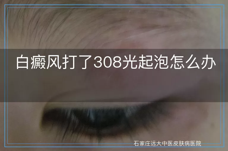 白癜风打了308光起泡怎么办