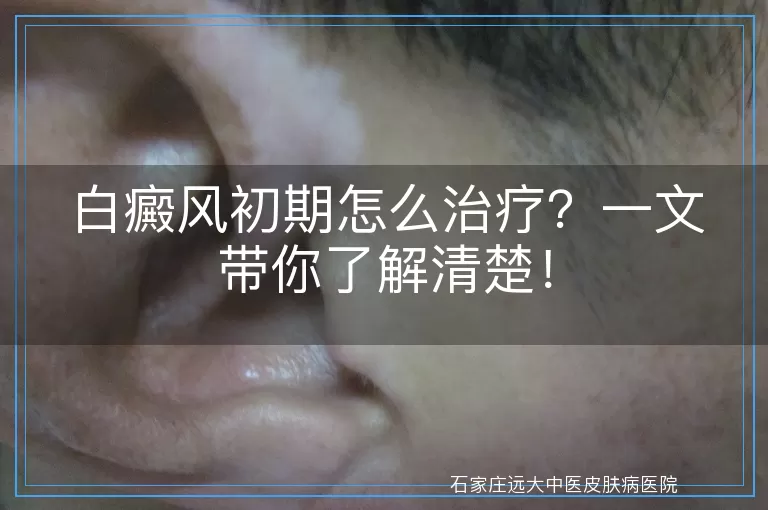 白癜风初期怎么治疗？一文带你了解清楚！