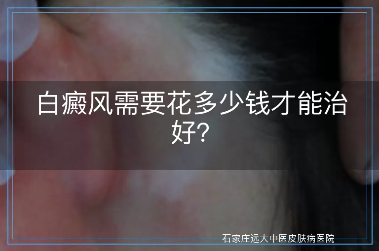 白癜风需要花多少钱才能治好？