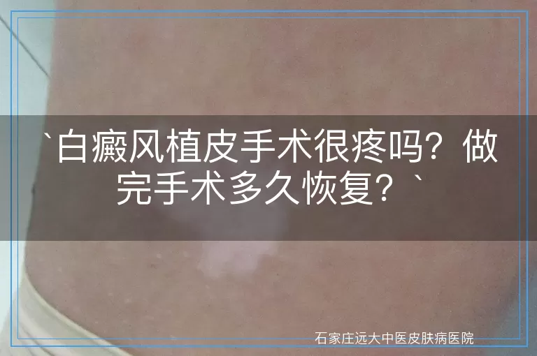 白癜风植皮手术很疼吗？做完手术多久恢复？