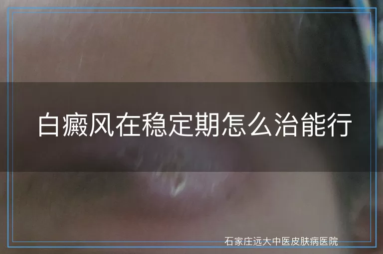 白癜风在稳定期怎么治能行