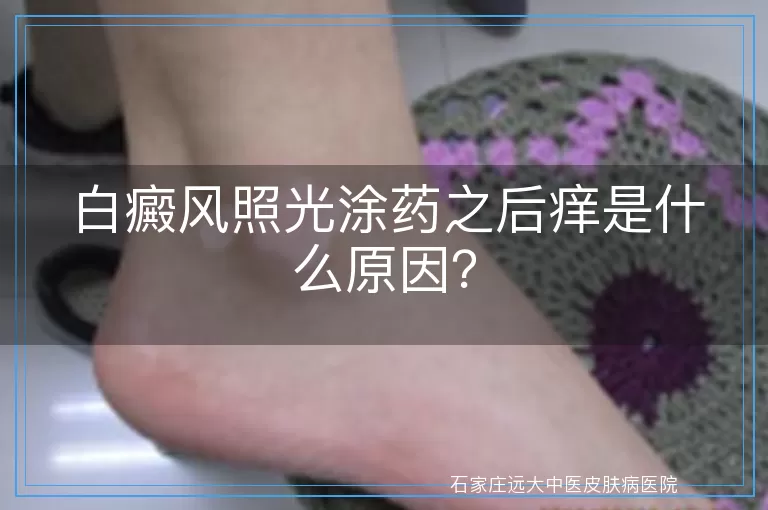 白癜风照光涂药之后痒是什么原因？