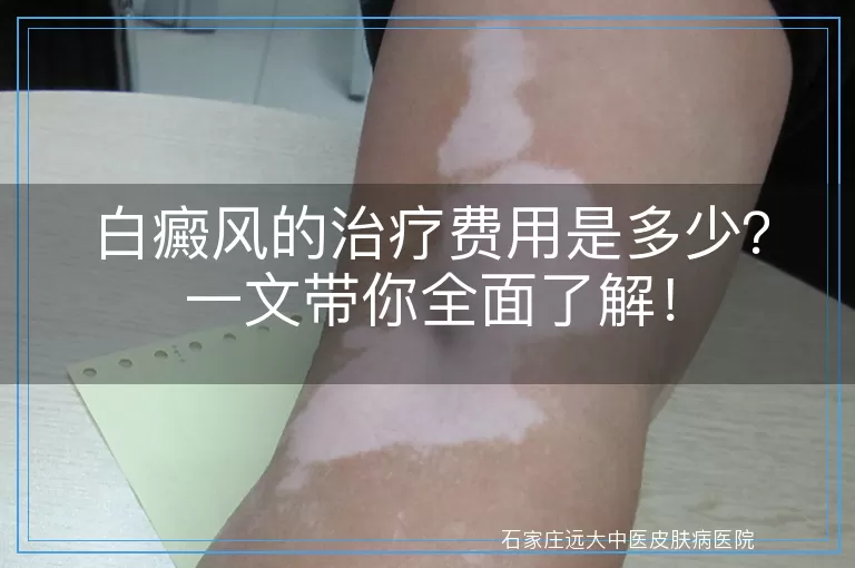 白癜风的治疗费用是多少？一文带你全面了解！