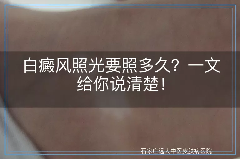 白癜风照光要照多久？一文给你说清楚！