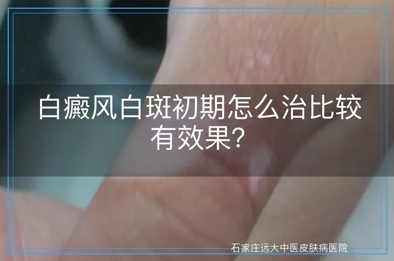 白癜风白斑初期怎么治比较有效果？