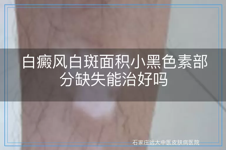 白癜风白斑面积小黑色素部分缺失能治好吗