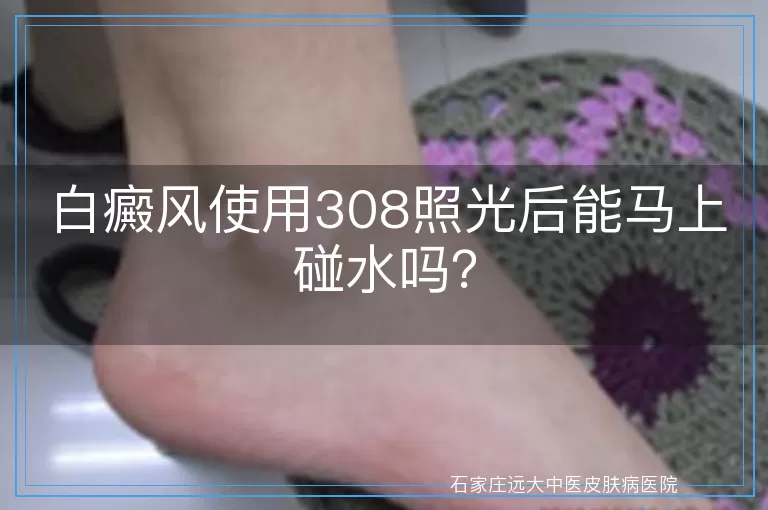 白癜风使用308照光后能马上碰水吗？
