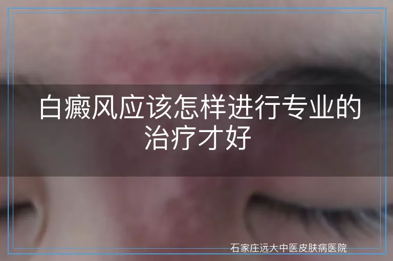 白癜风应该怎样进行专业的治疗才好
