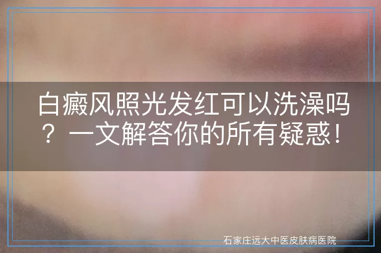 白癜风照光发红可以洗澡吗？一文解答你的所有疑惑！