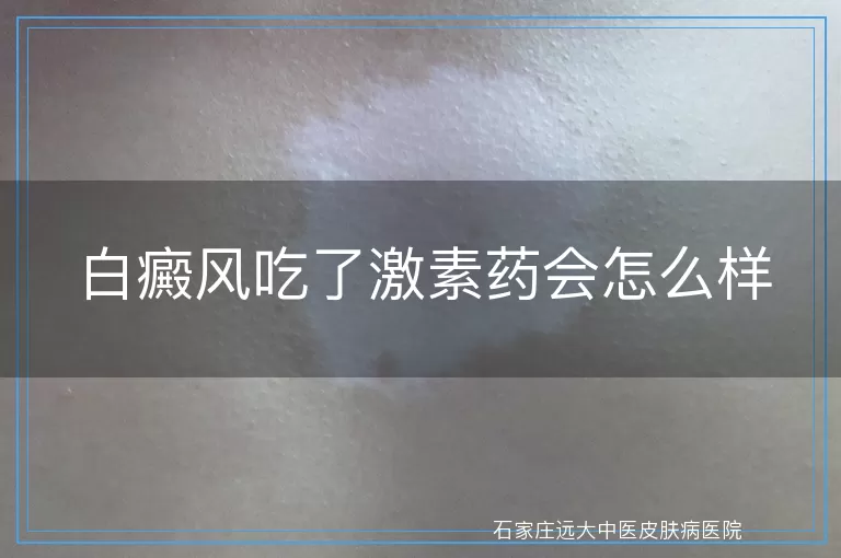 白癜风吃了激素药会怎么样