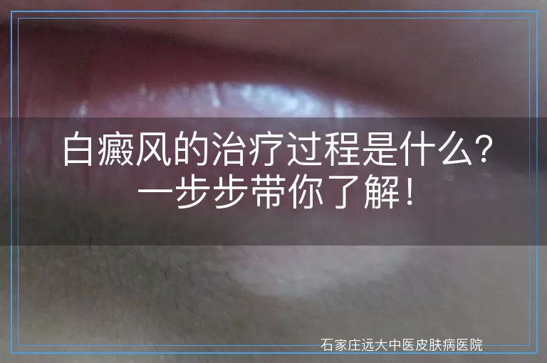 白癜风的治疗过程是什么？一步步带你了解！