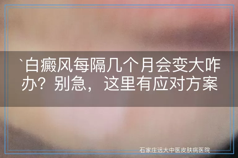 白癜风每隔几个月会变大咋办？别急，这里有应对方案！