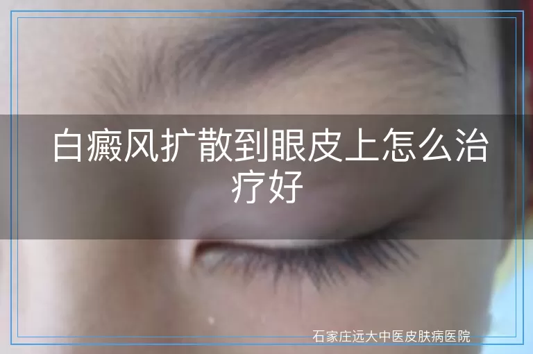 白癜风扩散到眼皮上怎么治疗好