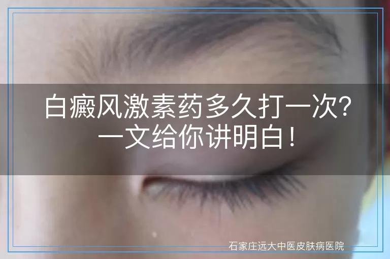 白癜风激素药多久打一次？一文给你讲明白！