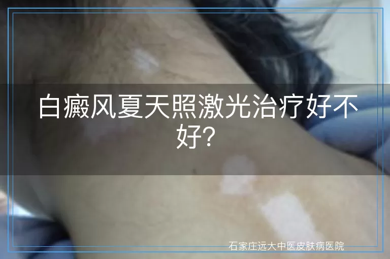 白癜风夏天照激光治疗好不好？