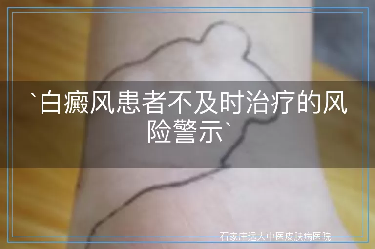 白癜风患者不及时治疗的风险警示