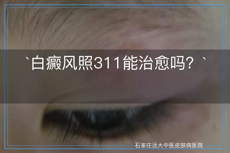 白癜风照311能治愈吗？