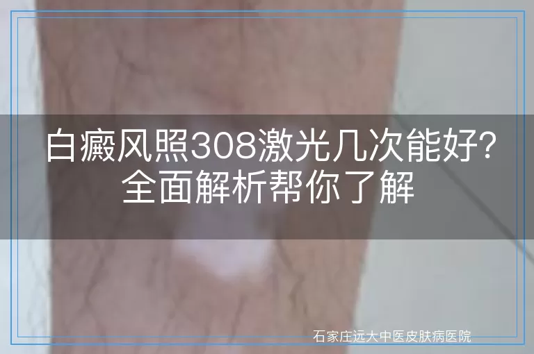 白癜风照308激光几次能好？全面解析帮你了解