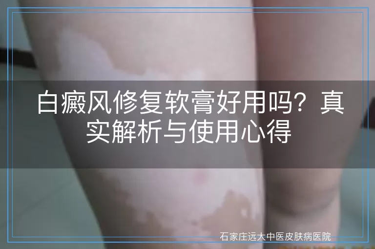白癜风修复软膏好用吗？真实解析与使用心得