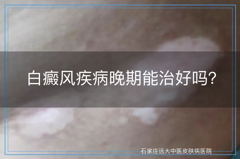 白癜风疾病晚期能治好吗？