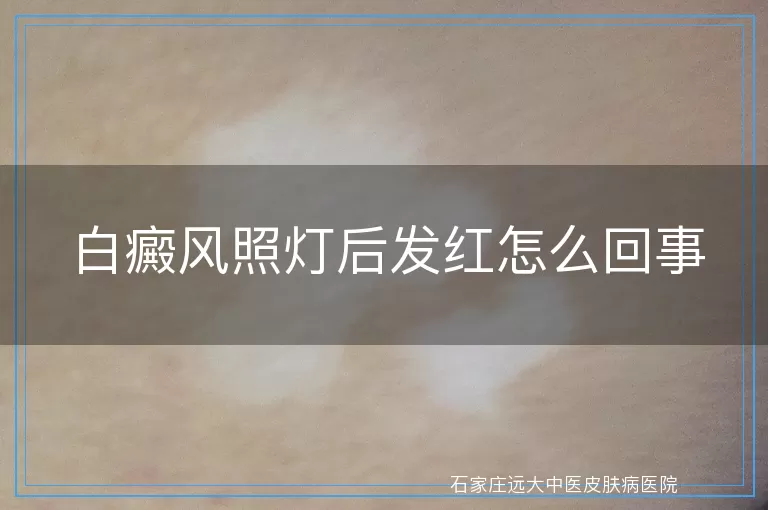 白癜风照灯后发红怎么回事